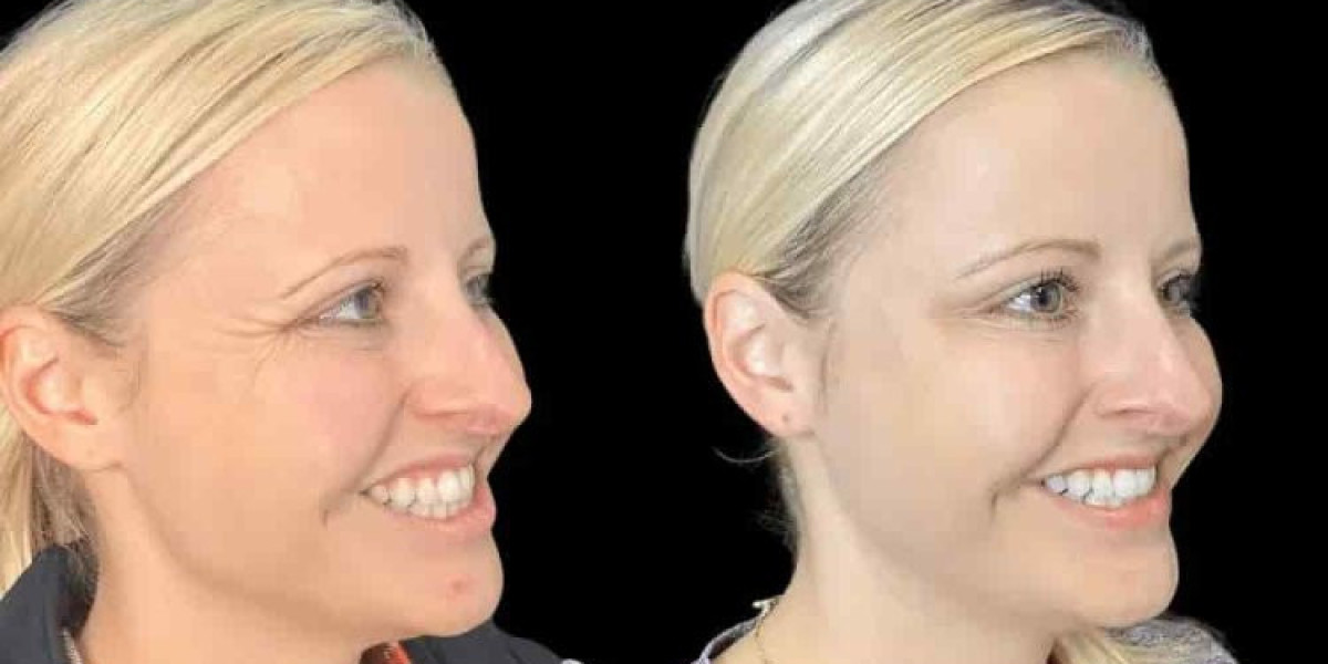 Best Plastic Surgeon in Dubai for Botox: A Guide to Personalized Treatment