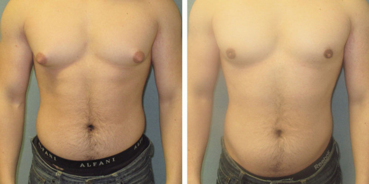 How Does Gynaecomastia Surgery in Dubai Work?